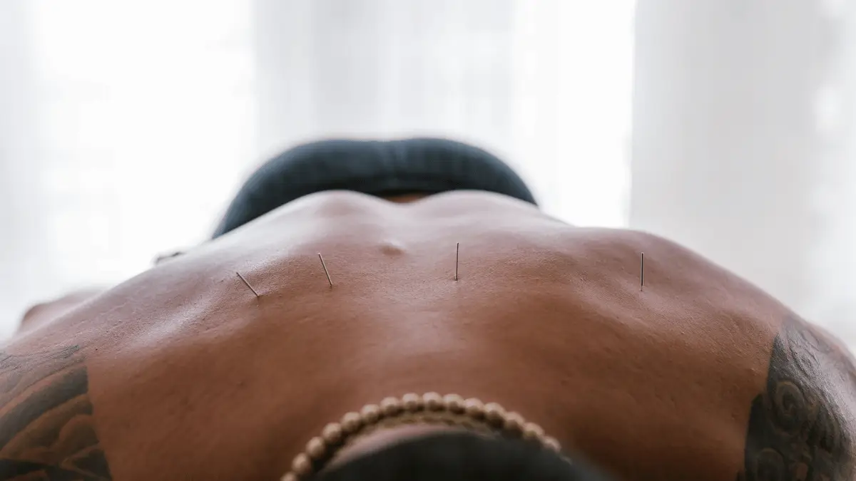 Tratamiento de acupuntura en la espalda con varias agujas